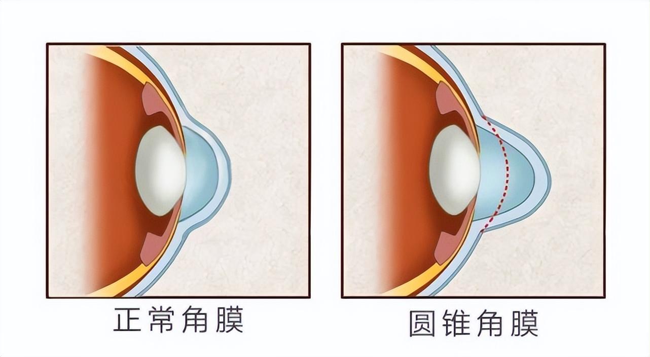 圆锥角膜最新治疗进展及其影响